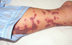 Não mô cầu tăng mạnh, trẻ em chiếm gần 50% ca mắc, nhận diện dấu hiệu 'tử thần'