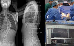 Cô gái soi gương thấy lưng có dấu hiệu lạ, không ngờ cột sống đã cong 53 độ