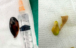 Bé 14 tuổi ho khan kéo dài, gia đình sốc khi bác sĩ lấy ra dị vật bên trong cơ thể