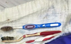 Gắp 3 bàn chải ra khỏi đường tiêu hóa một bệnh nhân tại Huế