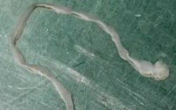 Người phụ nữ lên cơn co giật, bác sĩ lấy ra thứ đáng sợ trong não