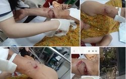 Chó lạ hung hãn tấn công 3 phụ nữ đi tập thể dục