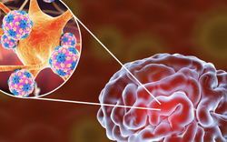 Bệnh nhi 2 tuổi bị viêm não mô cầu đã không qua khỏi