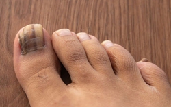 Dấu hiệu ở móng chân cảnh báo loại ung thư nguy hiểm: Nhiều người bỏ qua, bác sĩ khẩn thiết nhắc nhở