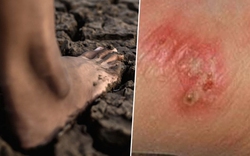 Thái Lan cảnh báo khẩn về dịch "sốt đất": 732 ca nhiễm, 23 trường hợp tử vong