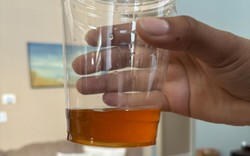 Ngày càng có nhiều người tử vong vì ung thư tuyến tụy, bác sĩ nhắc: Đừng xem nhẹ 3 thứ khi đi vệ sinh!