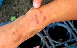 Thái Lan bật cảnh báo khi 23 người tử vong, 732 người bị lây nhiễm 1 căn bệnh, ở Việt Nam cũng đã xuất hiện