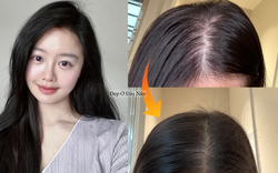 Tóc rụng đến nỗi lộ cả mảng da đầu, tôi quyết định theo 5 quy tắc chăm sóc sau để tóc đen dày trở lại