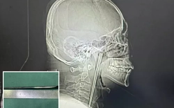 Hy hữu người đàn ông Trung Quốc sống 8 năm với chiếc đũa kim loại mắc trong cổ họng
