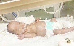 120 ngày giành giật sự sống cho bé sinh non 500gr phải thở máy kéo dài