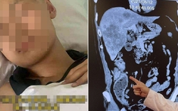 Thiếu niên 18 tuổi mắc ung thư đại trực tràng giai đoạn 3, bác sĩ nhắc: Người trẻ thường bỏ qua 2 dấu hiệu cảnh báo