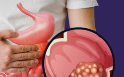 Phát hiện ung thư giai đoạn 4 ở tuổi 26, nam thanh niên hối hận: Giá như tôi không bỏ qua triệu chứng này