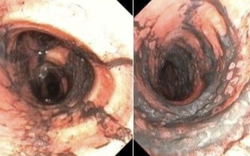 Ngạt khói nặng sau vụ cháy, đôi vợ chồng trẻ được hồi phục kỳ diệu