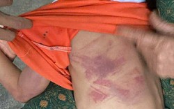 Bé gái lớp 2 bị bạn cùng lớp dùng thước đánh thâm tím người vì không cho kẹo