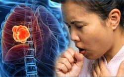 2 dấu hiệu khi ho cảnh báo ung thư phổi dễ bị bỏ qua