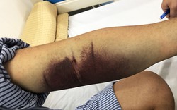 Gần 32.000 ca mắc, 4 ca tử vong: Bệnh viện Bạch Mai phát cảnh báo về 1 căn bệnh đang tăng nhanh, có thể suy đa tạng chỉ trong vài ngày