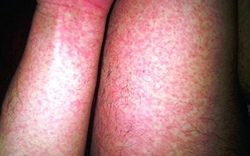 Gần 32.000 ca mắc, 4 ca tử vong: Bệnh viện Bạch Mai phát cảnh báo về 1 căn bệnh đang tăng nhanh, có thể suy đa tạng chỉ trong vài ngày