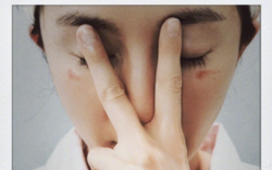 Dương Mịch bỏng mắt vì dùng mặt nạ hot