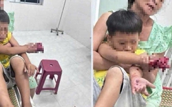 Cháu bé bị dập bàn tay nghi do điện thoại nổ lúc sạc pin