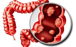 6 dấu hiệu cảnh báo đỏ của "căn bệnh ung thư đáng sợ": Có 1 cũng cần đi khám ngay!