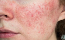 Hydroquinone và rủi ro từ hoạt chất "làm hồng" thần tốc trong mỹ phẩm