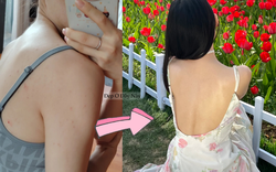 Cô nàng này áp dụng đúng 3 bước để làm sạch mụn lưng, tha hồ diện đồ hở mùa hè