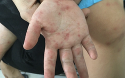 Làm gì để giảm nguy cơ tử vong và di chứng do bệnh tay chân miệng?