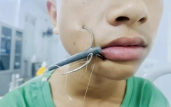 Bé trai 15 tuổi bị lưỡi câu móc sâu vào mặt khi đi câu cá