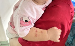 Nhiều ca tay chân miệng nặng tái nhiễm, bác sĩ kỳ vọng sớm có vaccine