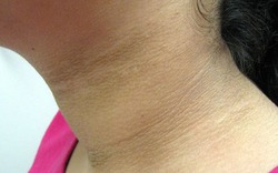 Dấu hiệu nguy hiểm nhất của bệnh tiểu đường hóa ra không phải khát nước hay tiểu nhiều, tôi đã rất hối hận vì bỏ qua bất thường này