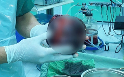 Đau bụng tưởng nhẹ, người đàn ông "sốc nặng" khi phát hiện thứ "đáng sợ" to bằng quả dưa lưới