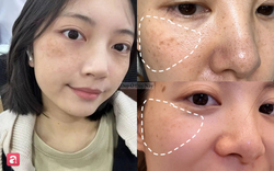Tiến sĩ da liễu tiết lộ 5 cách giảm thâm nám tại nhà nhiều người bỏ qua