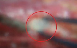 Người phụ nữ đau lưng suốt 2 năm, bác sĩ phát hiện ra bí mật "đáng sợ"