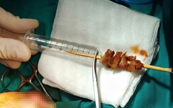 Cuộc hội chẩn xuyên đêm cứu bé gái gặp tai nạn hi hữu do que xiên thịt