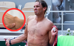 "Vua tennis" Rafael Nadal lộ bàn chân biến dạng vì căn bệnh hiếm