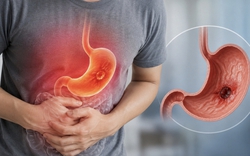 6 DẤU HIỆU sớm của ung thư dạ dày dễ xuất hiện trên cơ thể, nhiều người Việt lại bỏ qua vì tưởng chỉ là mệt