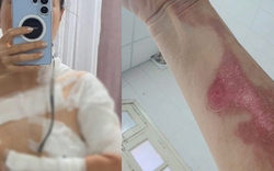 Đi gội đầu dưỡng sinh, cô gái nhận "combo sự cố": Bỏng độ 2, tự đi cấp cứu vì nồi xông hơi phát nổ?