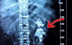 Cô gái trẻ nhập viện, bác sĩ phát hiện hai bên thận chi chít sỏi vì món đồ uống yêu thích