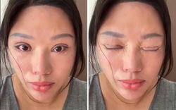 Phẫu thuật mí mắt hỏng, nạn nhân còn bị kiện ngược