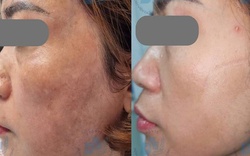 Nám da có nên điều trị bằng laser?