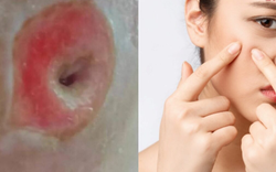 Người phụ nữ 40 tuổi chết lặng khi thấy mặt như "tổ ong" vì sai lầm ai cũng dễ mắc