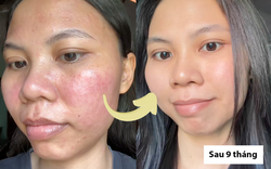 Hành trình dưỡng khí huyết "cứu" da hư tổn của cô nàng tuổi 30: Từng “toang” vì peel da, giờ da dẻ hồng hào, căng mịn, khỏe từ bên trong