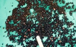 Đau bụng suốt nhiều tháng, người đàn ông 43 tuổi sốc nặng khi bác sĩ gắp ra thứ "đáng sợ" trong bụng