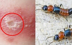 Những sai lầm phổ biến khi nhầm viêm da do kiến ba khoang với bệnh zona thần kinh