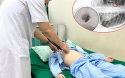 Bé trai 9 tuổi suýt tắc đường thở chỉ vì mẹ tự nhổ răng cho tại nhà