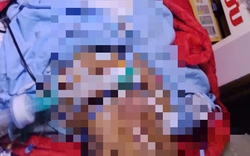 Bị bỏng nặng, mẹ đợi con thi xong tốt nghiệp THPT mới yên lòng nhắm mắt