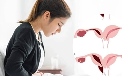 Đau bụng kinh suốt nhiều năm, nữ sinh 18 tuổi phát hiện dị tật hiếm: Bác sĩ bất ngờ khi thấy vòi tử cung đã hoại tử