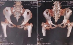 Bé gái 12 tuổi mắc "hội chứng người hóa đá" hiếm gặp, bố mẹ ngỡ ngàng khi bác sĩ nhắc tới cú ngã xe đạp 2 năm trước