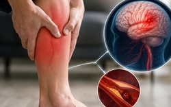 Chuyên gia cảnh báo: 5 dấu hiệu tại BẮP CHÂN có thể là tín hiệu cảnh báo đột quỵ, nếu thấy phải đi kiểm tra ngay