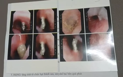 Niềng răng, vít chọc thẳng vào xoang mũi bệnh nhân, bệnh viện nói gì?